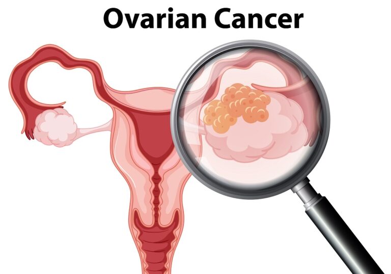 Ovarian Cancer