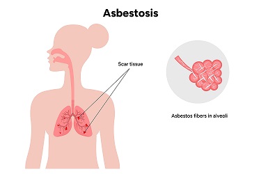 Asbestosis